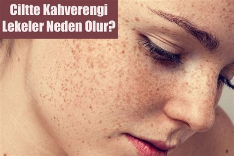 Ciltte Çatlak Neden Olur